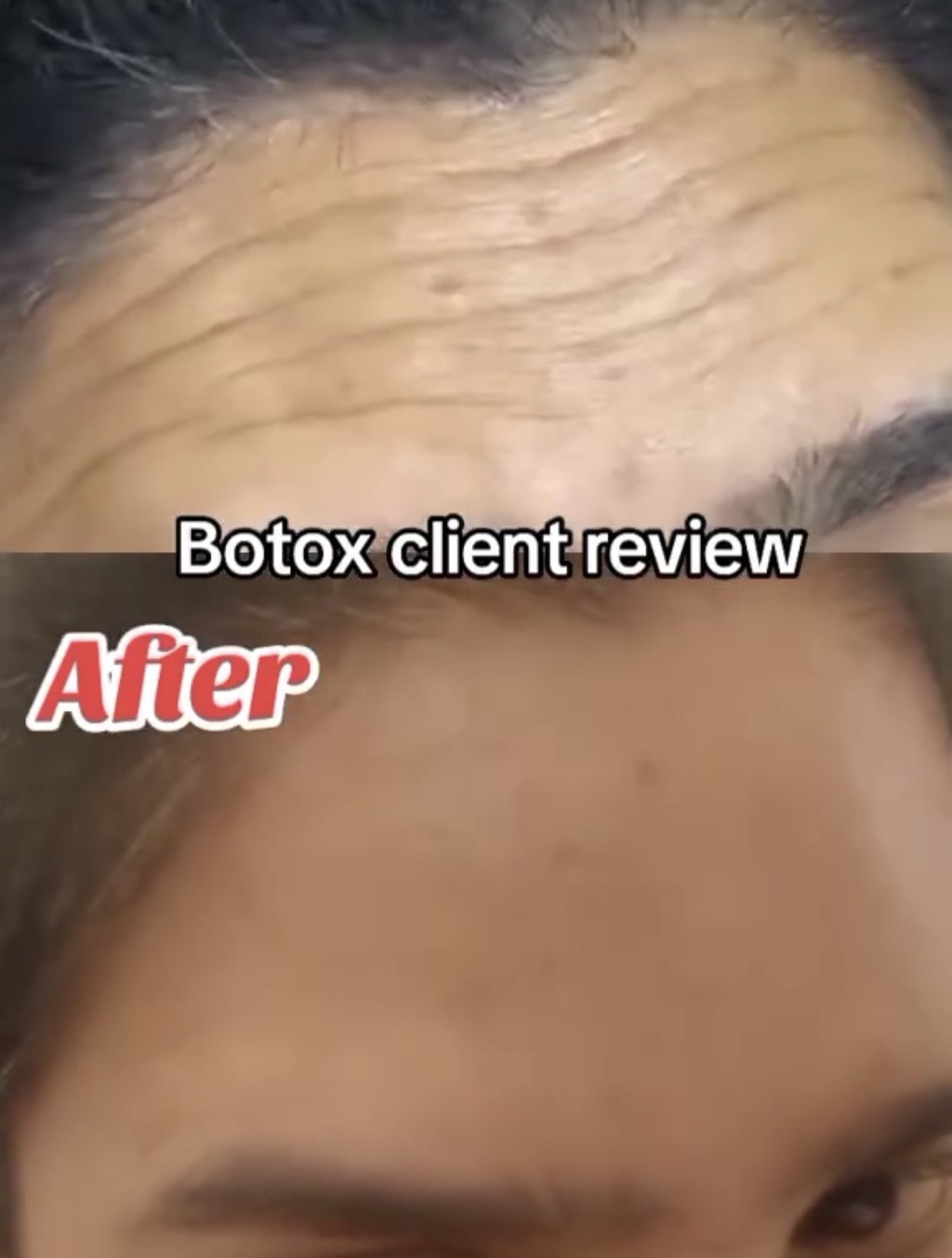 Botox before and after result
