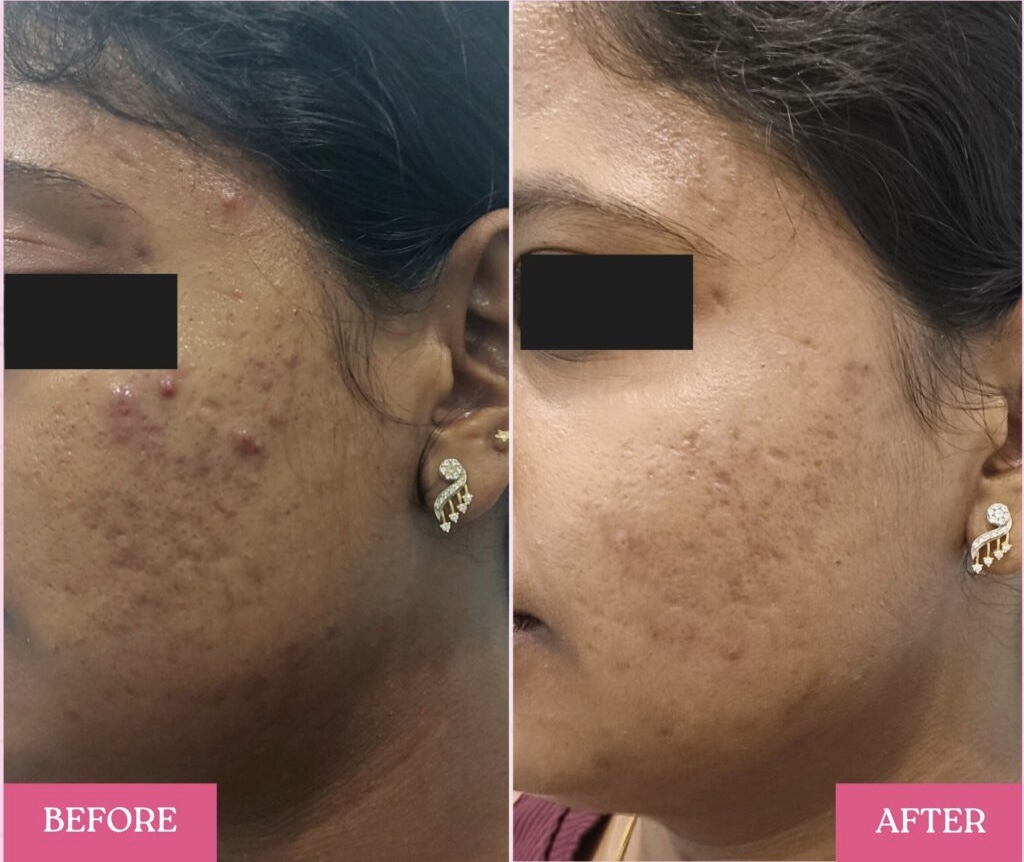 Chemical peel before and after result