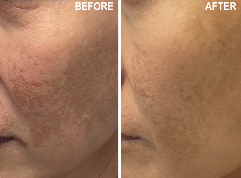 Pico laser before and after result