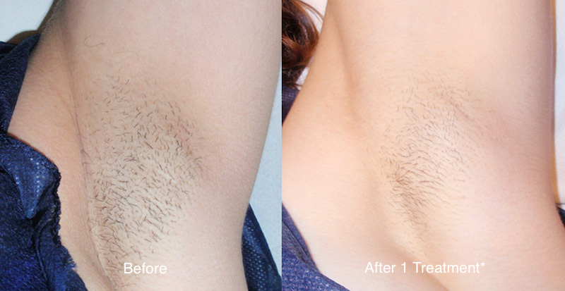 Underarm laser hair removal before and after result